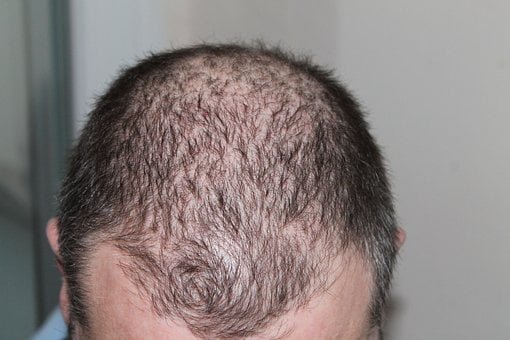 बालों का झड़ने रोके 7 दिन में। Stop Hair Loss Within 7 days