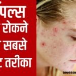 पिंपल्स को रोकने का सबसे बेस्ट तरीका Health Tips